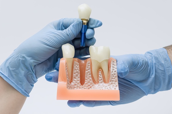 Tooth Replacement    : The Long Term Health Benefits Of Dental Implants